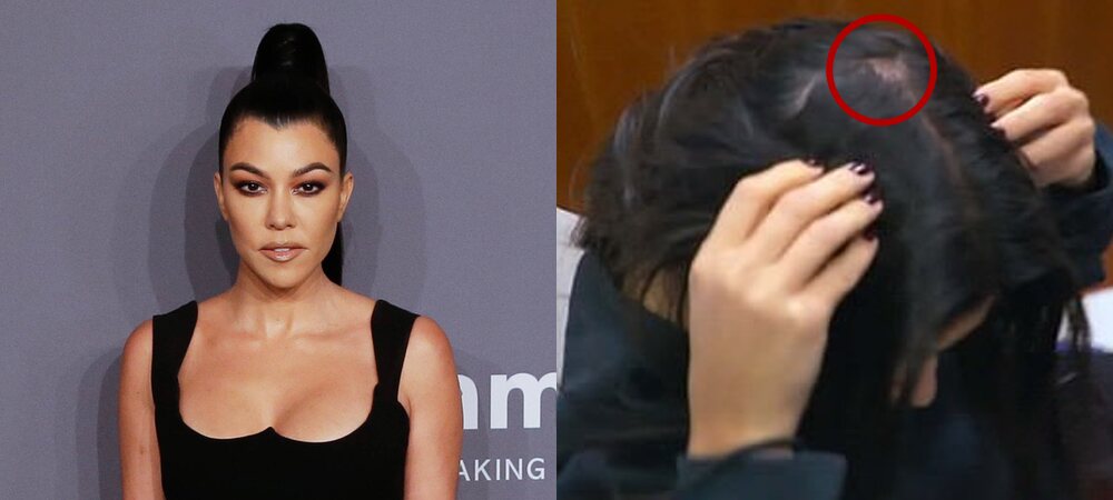 Kourtney Kardashian's Traction Alopecia |  Photos: Gtres / 'KUWTK'