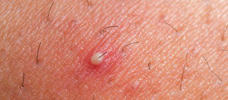 Folliculitis is a very common problem