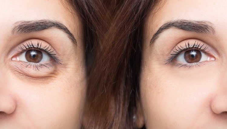 La genética también influye en la aparición de bolsas en los ojos
