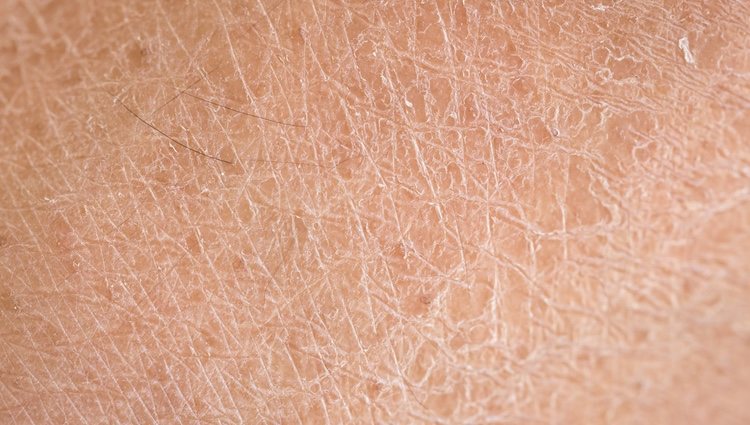 Como está mal nutrida, la piel no cumple eficazmente su función barrera