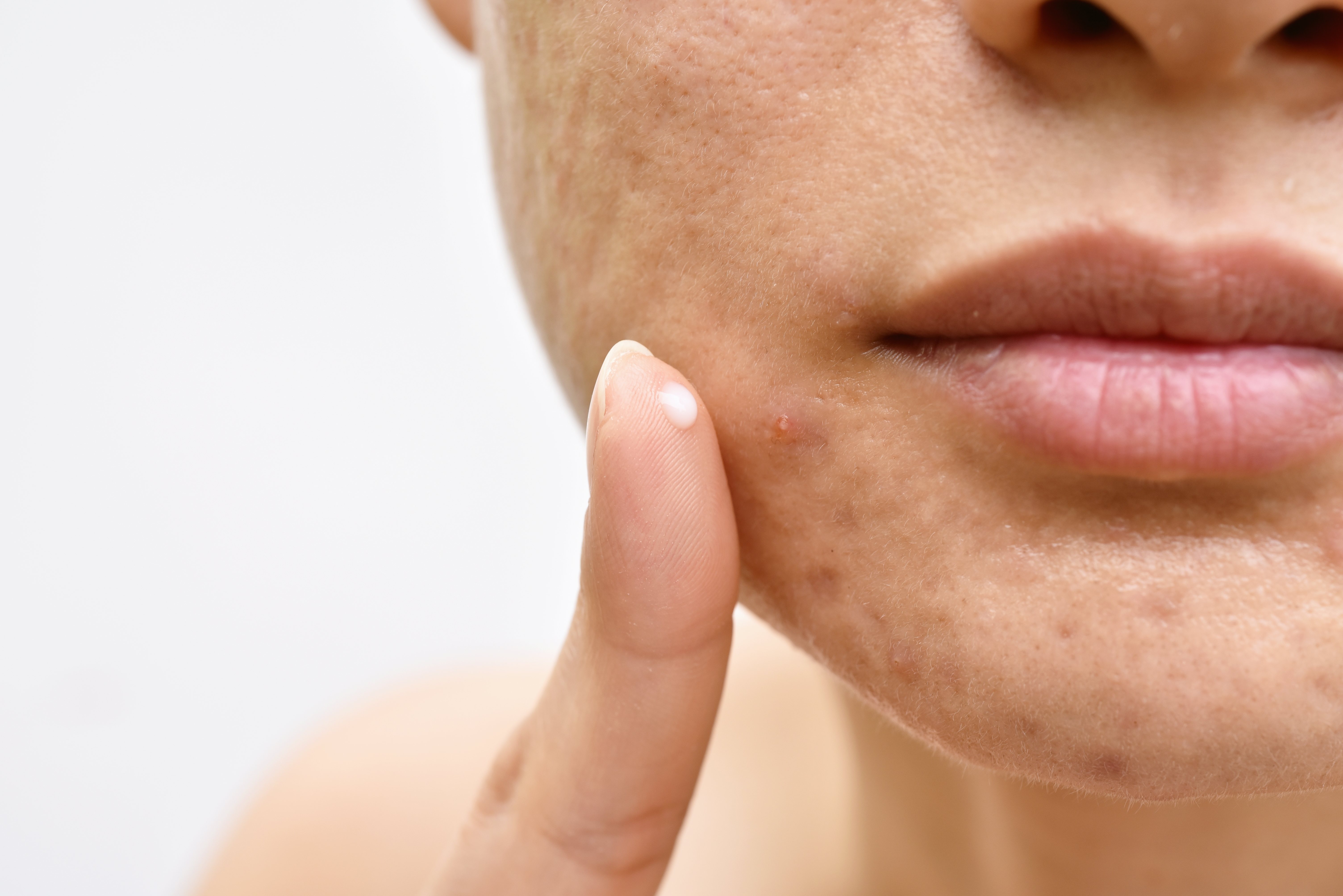 El acné es una de las enfermedades más comunes