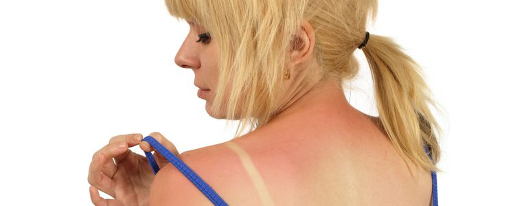 El sol puede provocar enrojecimiento y picores en la piel