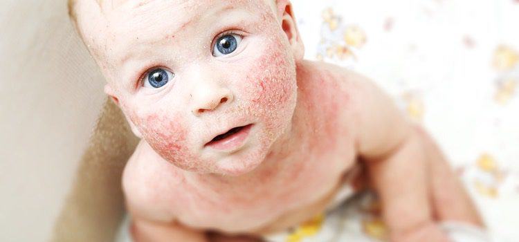 La dermatitis atópica suele aparecer en niños y bebés