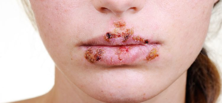 El herpes puede salir tanto en la cara como en los genitales