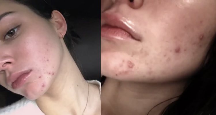 Kendall Jenner muestra sus brotes de acné en su presentación como rostro de Proactiv