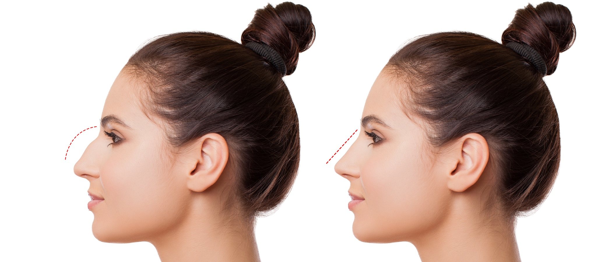 Rinoplastia: todo lo que necesitas saber sobre la cirugía de nariz