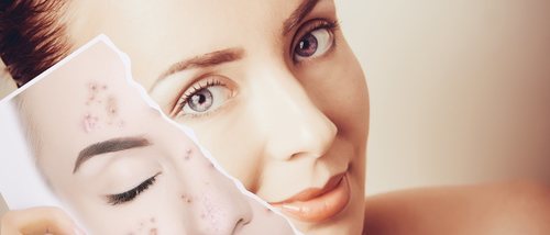 Mitos sobre el acné: verdades y mentiras