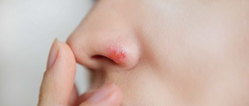 Herpes en la nariz: cómo curarlo y cómo disimularlo