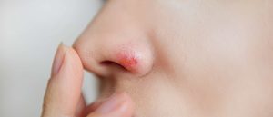 Herpes en la nariz: cómo curarlo y cómo disimularlo