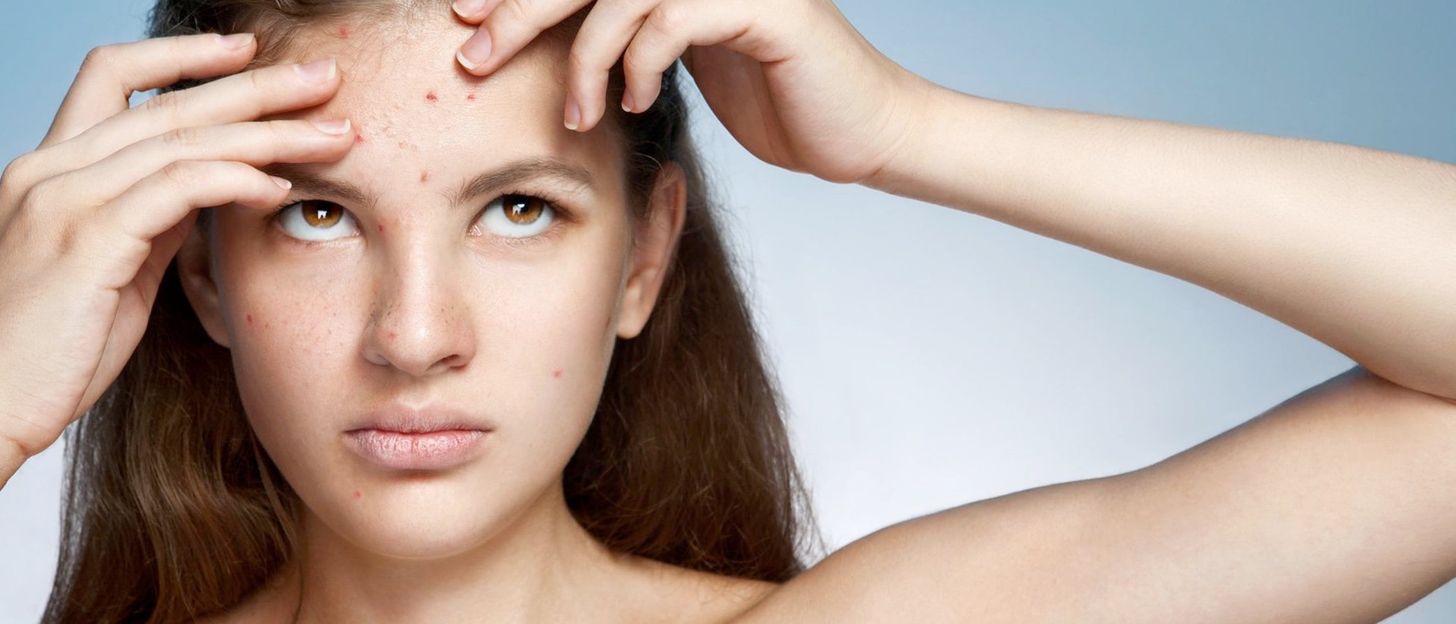 Cómo cuidar la cara con acné en verano
