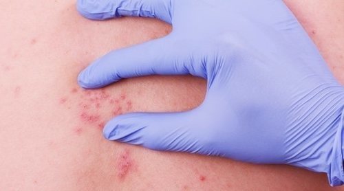 Herpes zóster: cómo disimularlo y curarlo