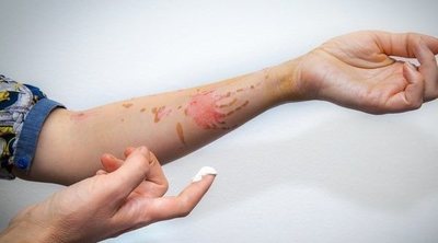 Quemaduras con aceite: cómo evitar que salgan manchas en la piel